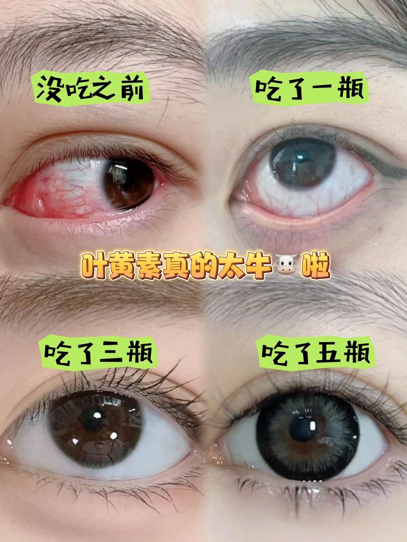 吃叶黄素糖患干眼症